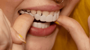 Snap on Smile Veneers